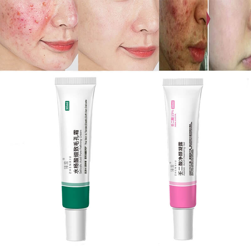 Salicylic Acid Cream Oil Control Anti-Acne Face Cream