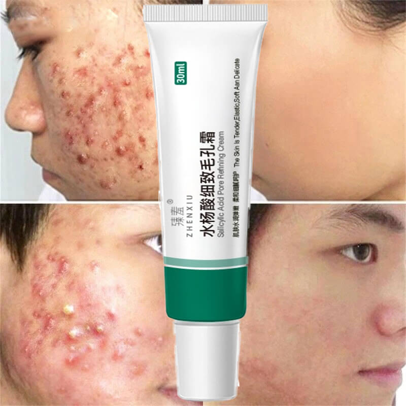 Salicylic Acid Cream Oil Control Anti-Acne Face Cream
