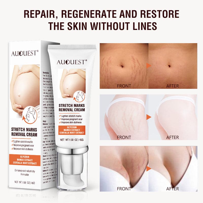 TikTok Maternity Stretch Marks Removal Cream