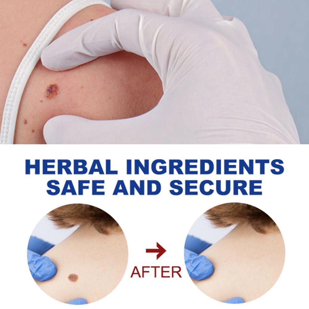 2023 New Removing Against Moles Liquid Pen