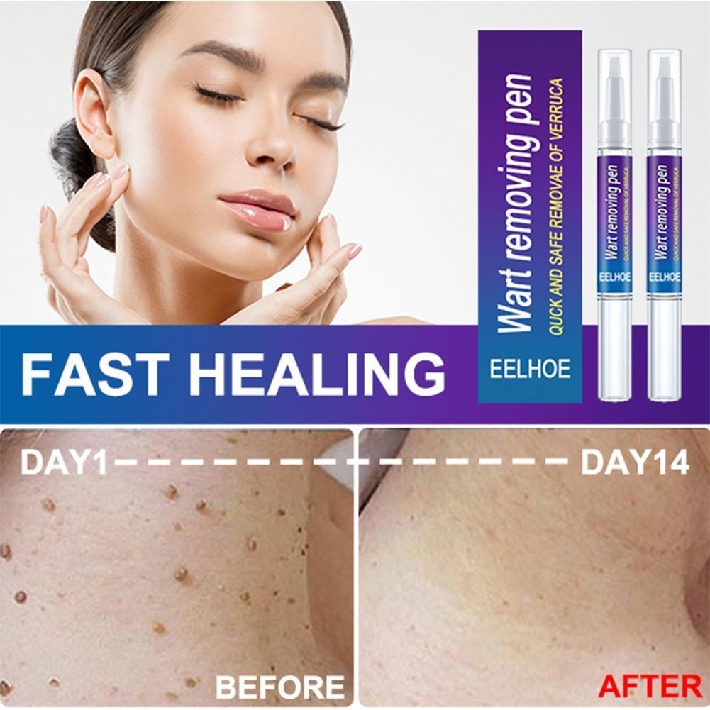 2023 New Removing Against Moles Liquid Pen
