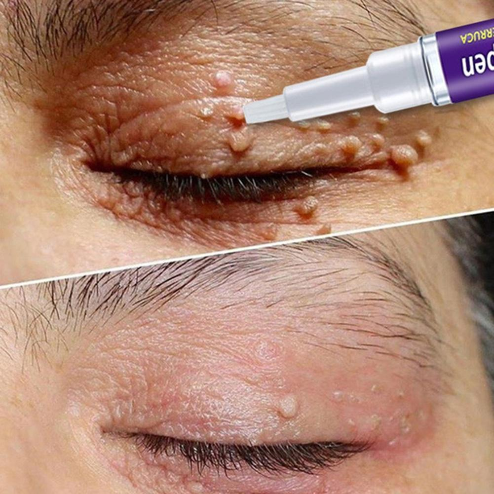 2023 New Removing Against Moles Liquid Pen