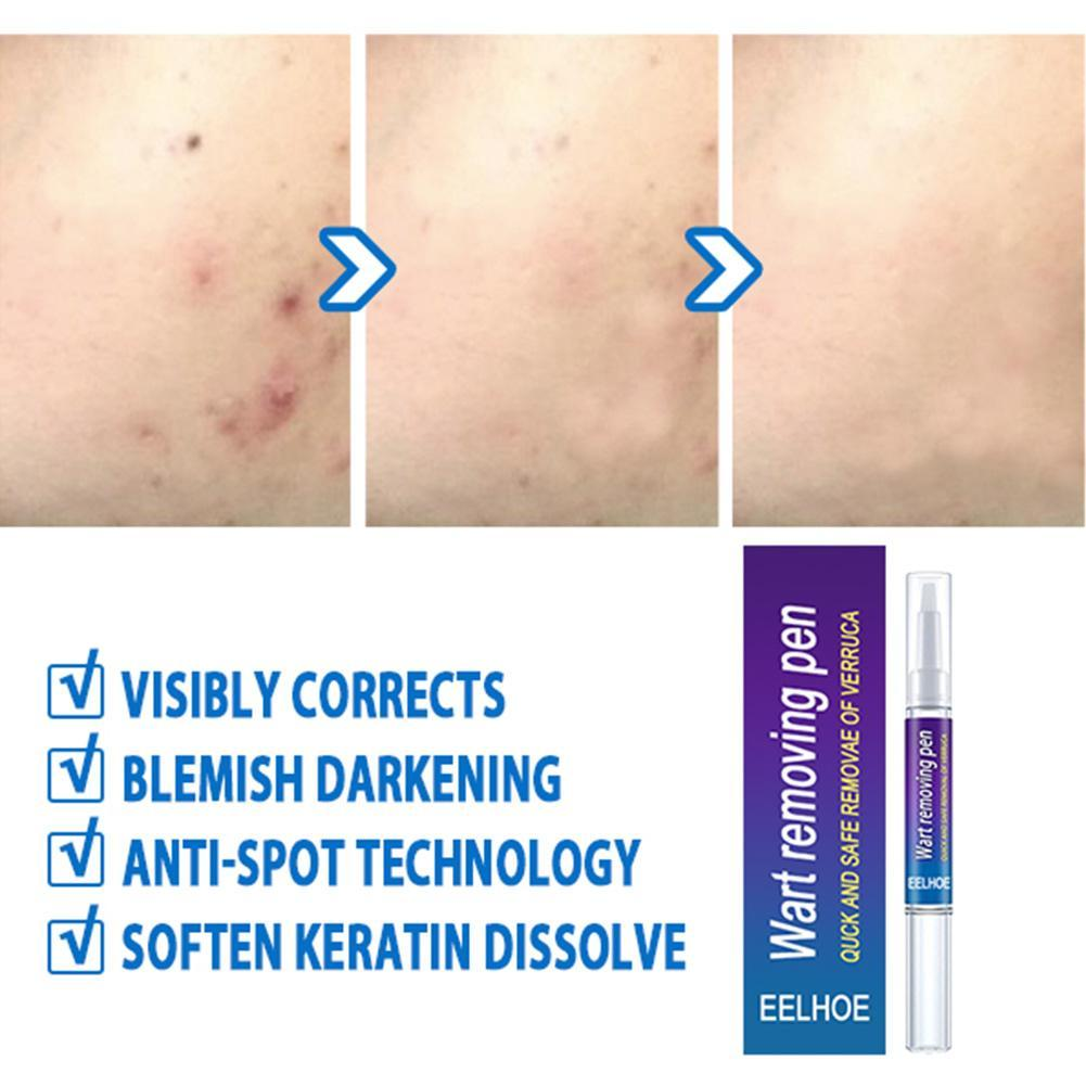2023 New Removing Against Moles Liquid Pen